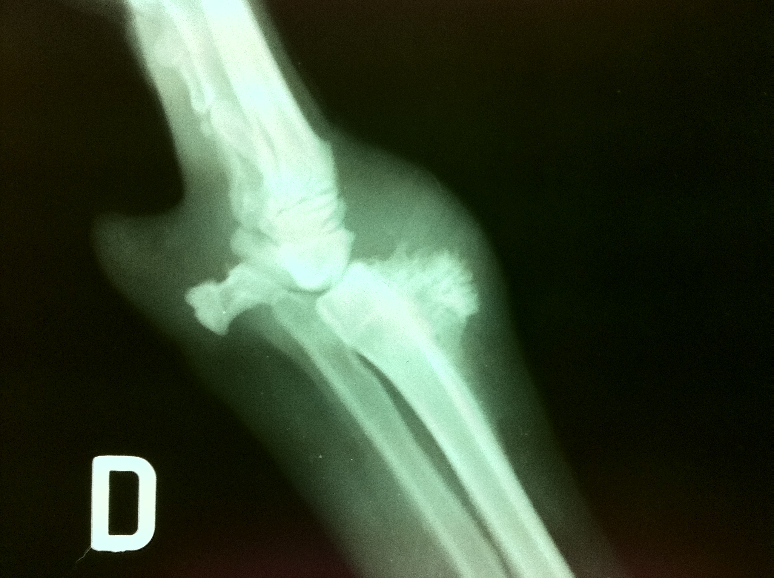 Osteosarcoma